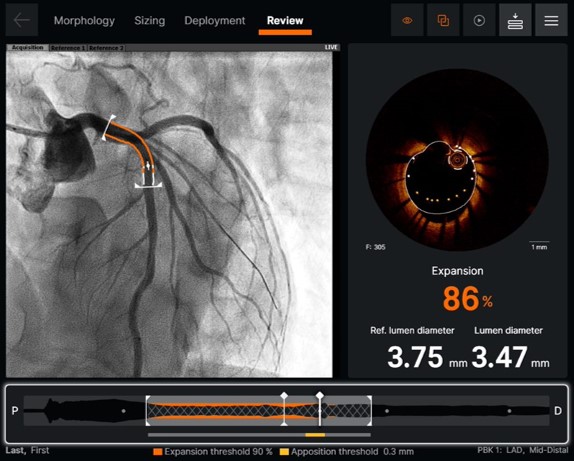 Abbott s Ultreon OCT Imaging Software Receives FDA Clearance Cardiac 