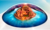 Welcome to Dry Eyeland Resource image