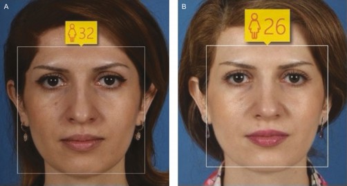 AI Study: Rhinoplasty Makes Women Look Up to Three Years Younger image