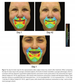 Dermal Fillers Also Restore Youthful Facial Movement image